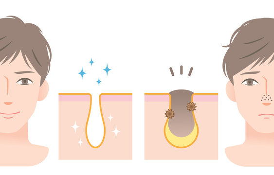 角栓除去photos Royalty Free Images Graphics Vectors Videos Adobe Stock