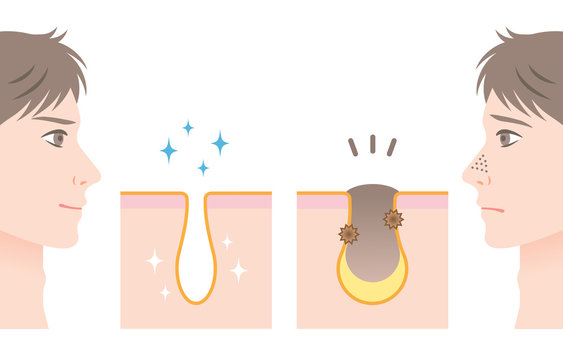 角栓除去photos Royalty Free Images Graphics Vectors Videos Adobe Stock