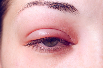 Fototapeta na wymiar Barley infection on the eye