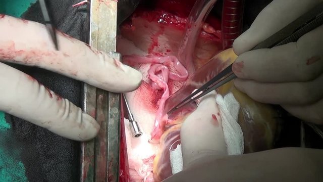 Heart surgery unique macro video close up in clinic. Struggle for life. Operation on live organ of patient in hospital.