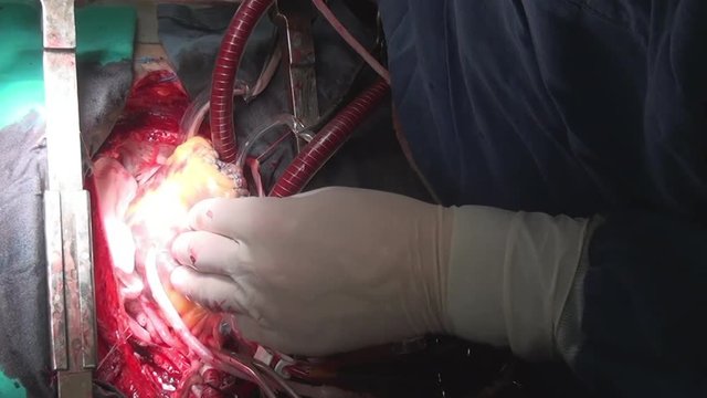 Surgeon's hands make heart surgery in clinic. Process of struggle for life of patient. Unique macro video in hospital.