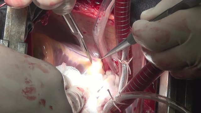 Cut heart plane by surgeon professional doctor unique macro video in clinic. Process of struggle for life of patient. Operation on live organ of person in hospital.