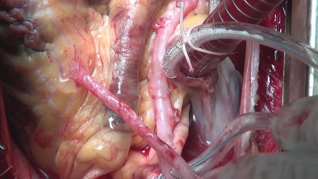 Heart during operation on live organ of person in clinic. Process of struggle for life of patient. Unique macro video in hospital.