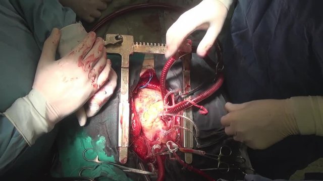 Heart surgery operation on live organ unique macro video close up in clinic. Struggle for life. Patient in hospital.
