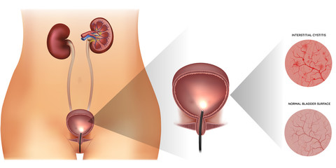 Urinary bladder examination, healthy lining and unhealthy inflamed lining with cystitis on a white background. Female silhouette and detailed urinary system.