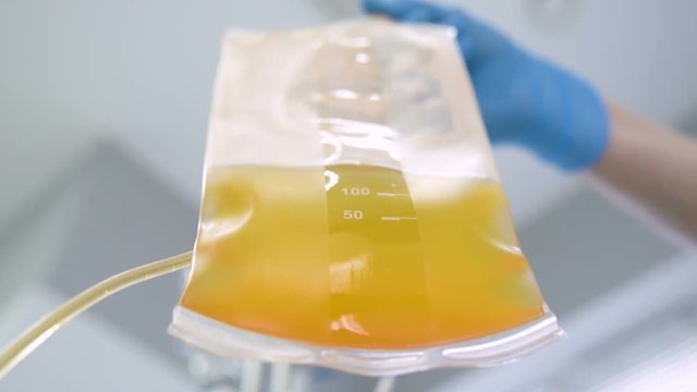 Plasmapheresis - the process of excretion of blood plasma from the circulation