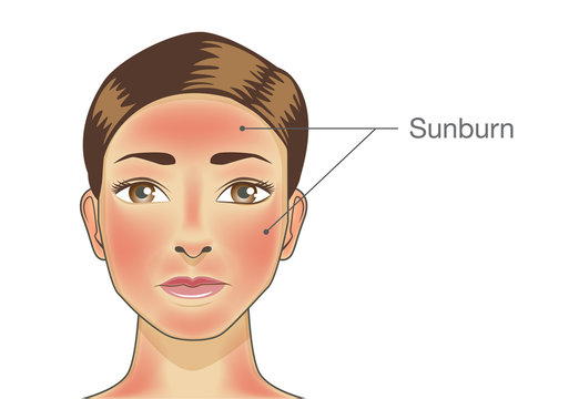 Burned skin on facial of woman and neck. Illustration about danger of Ultraviolet radiation.