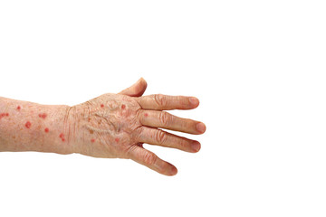 medicine, hand of an elderly man who has herpes isolated on a white background