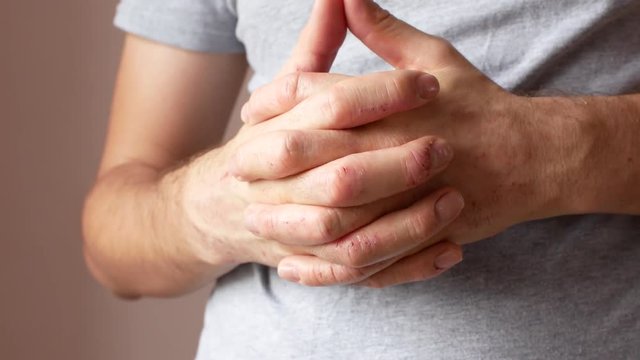 Hands of a man with psoriasis. Paren is nervous and scratches his hands