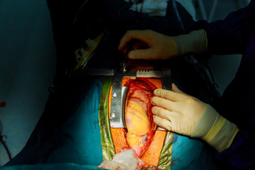 Surgeon pinches the blood circulation during the open heart surgery