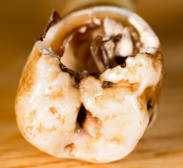 Caries on the teeth of a man