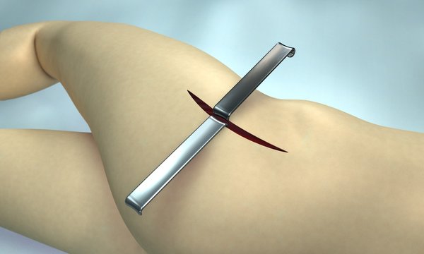 Hip Surgery - Medical 3d Visualisation