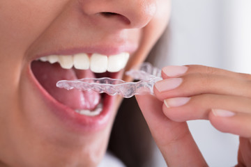 Woman's Hand Putting Transparent Aligner