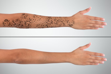 Woman's Hand Before And After Laser Tattoo Removal