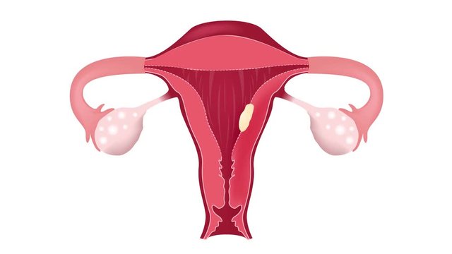 cancer and tumor in women uterus graphic