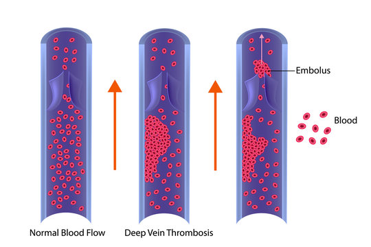 Thrombosis. Vector illustration
