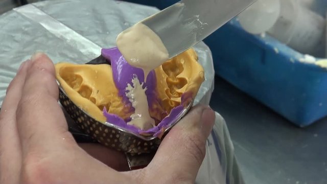 Close-up of the hands of a dentist who is pouring plaster in a dental mold. Dental impression in a laboratory.