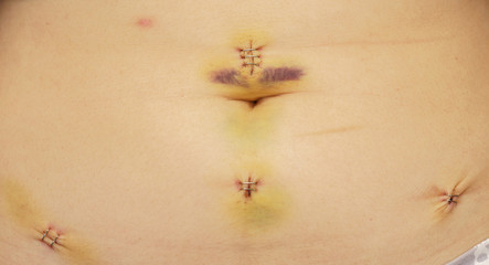 Fototapeta na wymiar Closeup of woman abdomen after myomectomy by laparoscopy