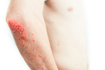 on the Elbows Psoriasis