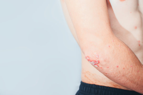 on the Elbows Psoriasis