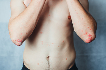 Naklejka premium on the Elbows Psoriasis