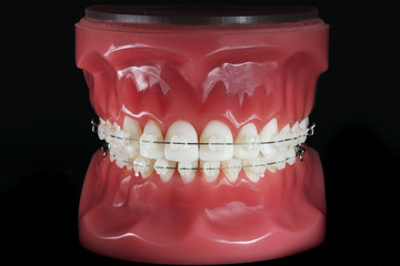 mock artificial jaw with braces on a black background