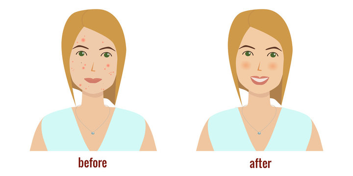 Woman's face with skin problems before and after skin treatment.. Acne, pimples. Skin troubles. Vector illustration.