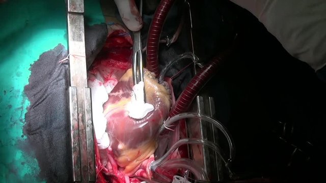 Heart during operation on live organ of person in clinic. Process of struggle for life of patient. Unique macro video in hospital.