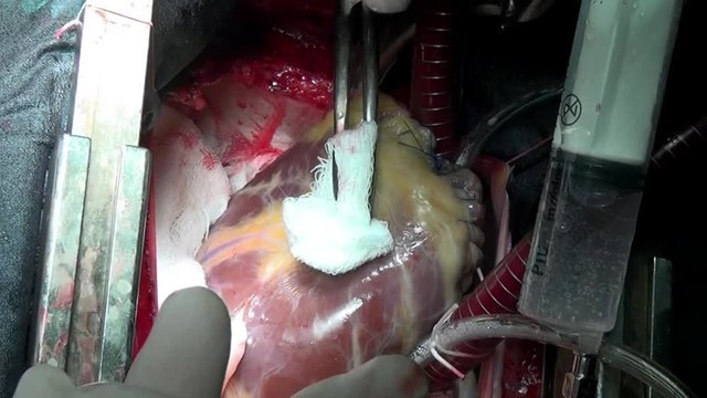Surgeon's hands make heart surgery in clinic. Process of struggle for life of patient. Unique macro video in hospital.