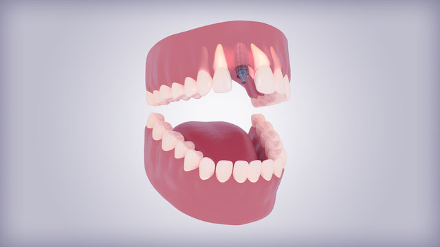implante dental