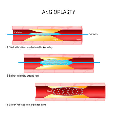 Angioplasty. Stent Implantation.