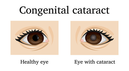 Illustration of Congenital cataract - obrazy, fototapety, plakaty