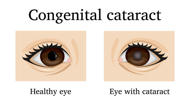 Illustration Of Congenital Cataract