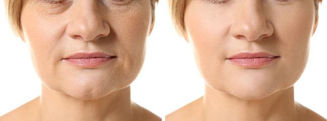 Mature woman before and after biorevitalization procedure on white background - obrazy, fototapety, plakaty