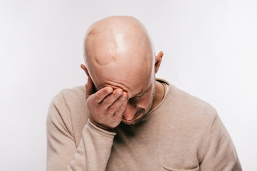 Bald man psychological stress struggling for life arter brain tumor. Heartbreaking male emotions...