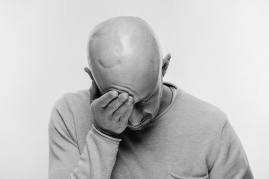 Bald Man Psychological Stress Struggling For Life Arter Brain Tumor. Heartbreaking Male Emotions After Cancer Neurosurgery Operation. Oncology Survivor Patient. Chemotherapy And Irradiation Head Marks