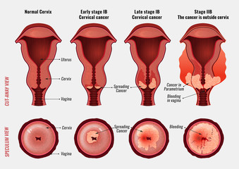 Cervical cancer image