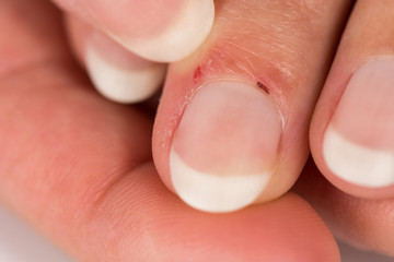 Injured skull with nail on hand.
