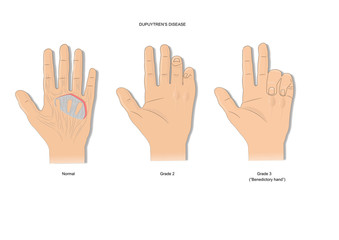 dupuytren's contracture (or disease): a condition where the palmar fascia become thickened with nodules that bend fingers.