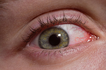 Inflamed sick human eye macro