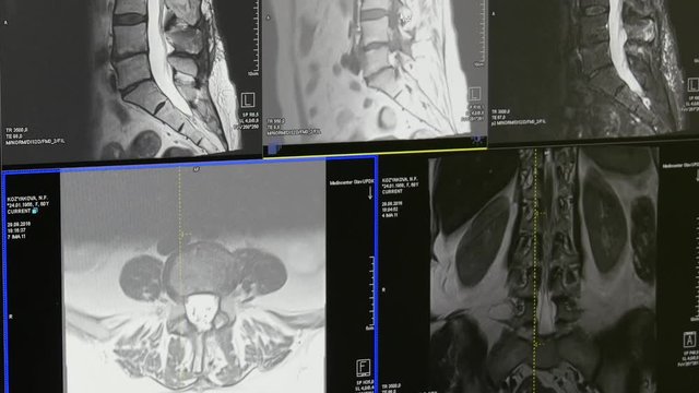 Spinal cord and spinal column tomography on MRI scan. Diagnosis of a person in the clinic. Professional Medical Equipment.