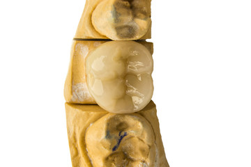dental prosthesis cermet tooth crown on gypsum model of teeth closeup isolate on white background