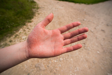 Easily injured hand of a woman after fall in the tourist walk