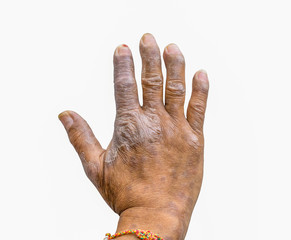 Closeup of psoriasis on the hands of farmers isolated on white background, dermatology skin...