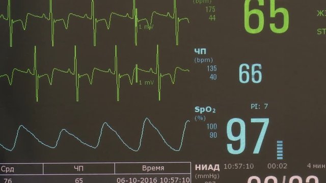 Cardiogram of rhythm of heart and pulse image on monitor during operation. Professional work of surgeon doctor.