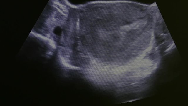 Image of female womb on monitor ultrasound examination equipment. Diagnosis of a person in the clinic.