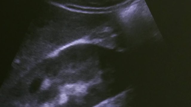 Image of woman uterus on monitor ultrasound examination equipment. Diagnosis of a person in the clinic.