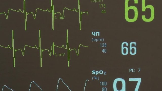 Cardiogram of rhythm of heart and pulse image on monitor during operation. Professional work of surgeon doctor.