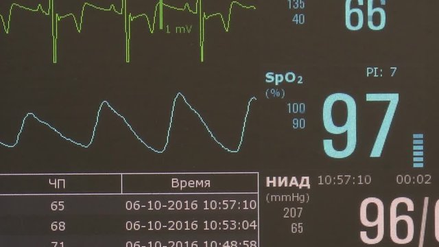 Cardiogram of rhythm of heart and pulse image on monitor during operation. Professional work of surgeon doctor.