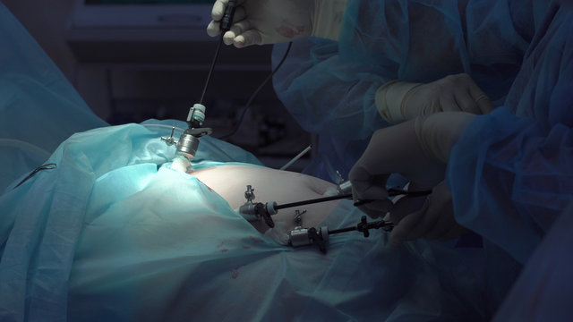Operation using laparoscopic equipment. Surgeons team. Hospital.